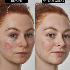 The INKEY List Azelaic Acid 10% Serum< Serum