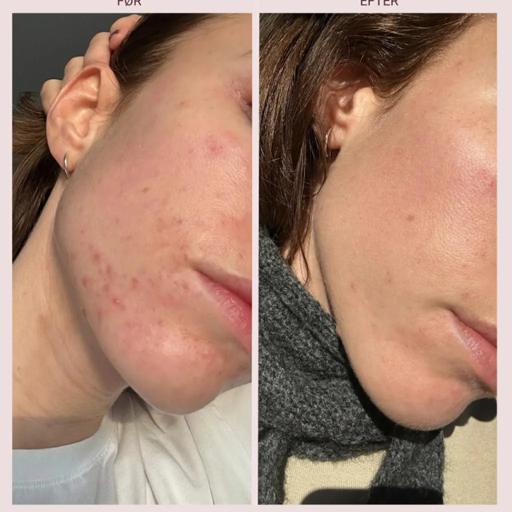 Pudderdåserne Azelainsyre 10%< Serum