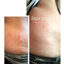 âme pure Body Basic - Stretch Marks<Børn Hudpleje Til Gravid Og Nybagt Mor|Hudpleje Til Gravid Og Nybagt Mor