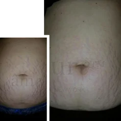 âme pure Body Basic - Stretch Marks<Børn Hudpleje Til Gravid Og Nybagt Mor|Hudpleje Til Gravid Og Nybagt Mor