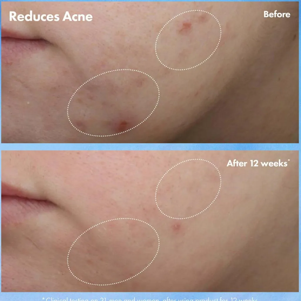 Origins Clear Improvement Acne & Blackhead Clearing Hydrating Moisturizer Lotion< Natcreme