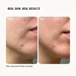 Common Clouds Cloud Patch Centella Spot Care< Masker