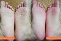 Baby Foot Fodpleje<Exfoliation Foot Peel