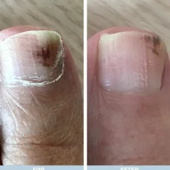 Australian Bodycare Fod og Neglepakke til Hård Hud< Neglesvamp|Fodpleje