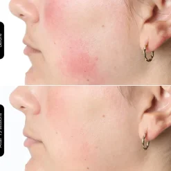 Silk'n Ansigtsbehandling<LED Face Mask 100