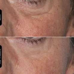 Silk'n Ansigtsbehandling<LED Face Mask 100