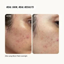 Common Clouds Moon Patch XL Centella Spot Care< Masker