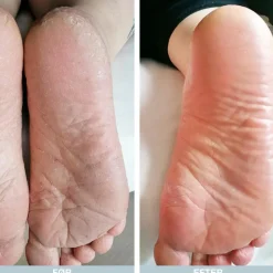Australian Bodycare Såler & Indlæg|Fodpleje<Pakke mod Sure Tæer