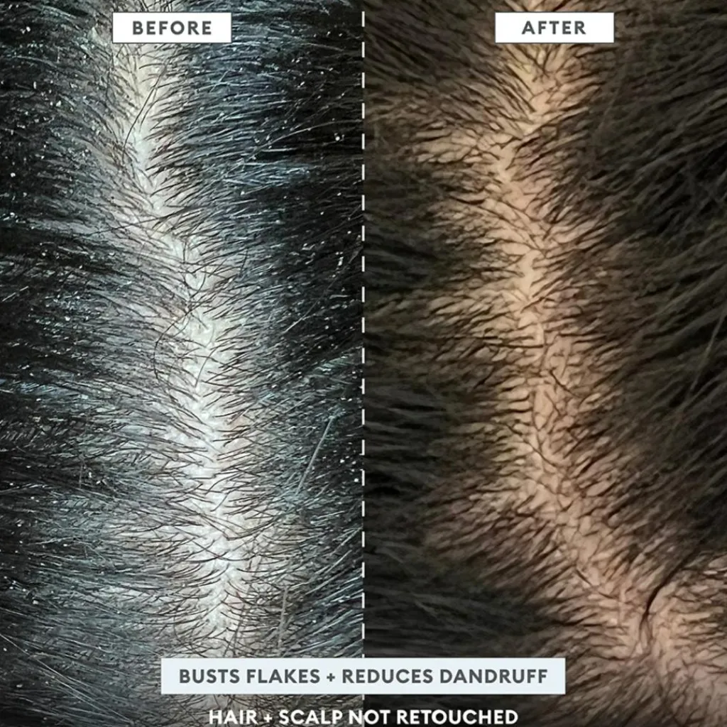 Briogeo Hovedbundspleje<Scalp Revival™ MegaStrength+ Dandruff Relief Shampoo Charcoal + AHA/BHA