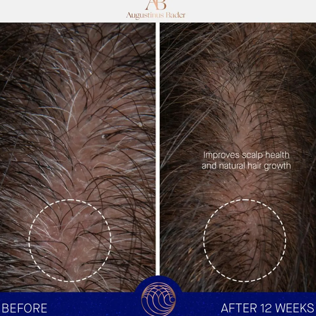 Augustinus Bader The Scalp Treatment< Hovedbundspleje