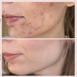 Pudderdåserne Problemhud|Masker<T-Zone Peeling