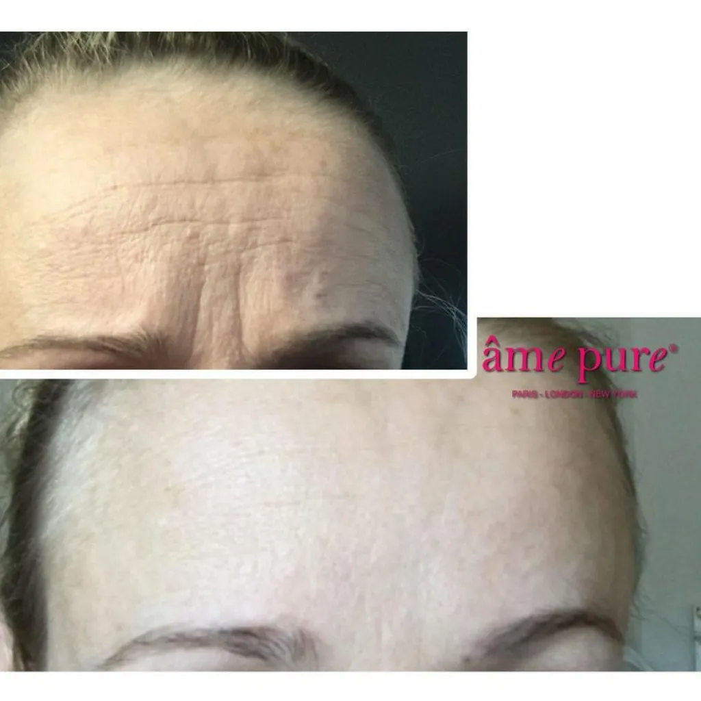 âme pure WrinkleEraser Basic Kit< Ansigtsbehandling|Anti-Age