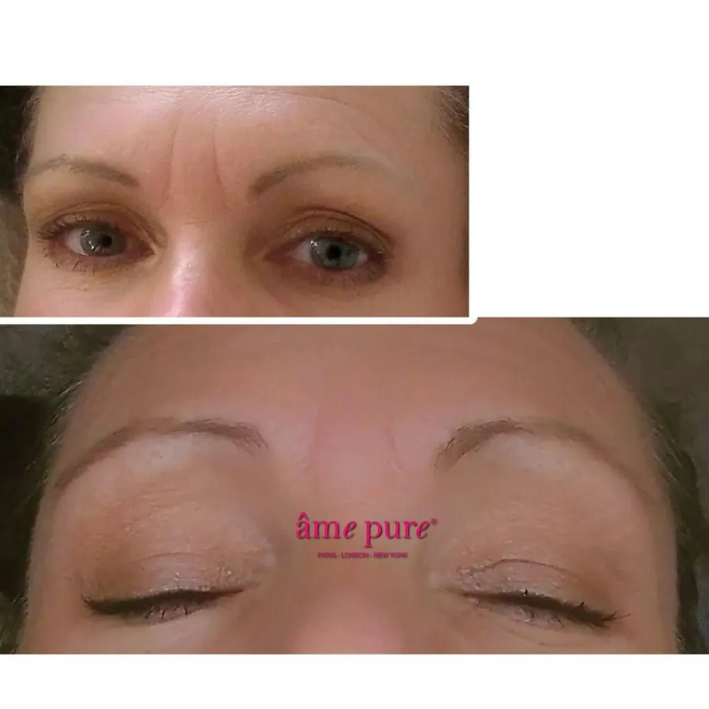 âme pure WrinkleEraser Basic Kit< Ansigtsbehandling|Anti-Age