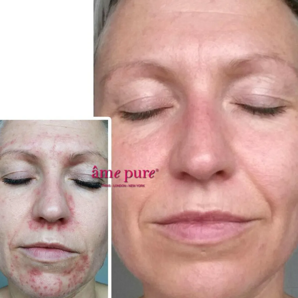 âme pure WrinkleEraser Basic Kit< Ansigtsbehandling|Anti-Age